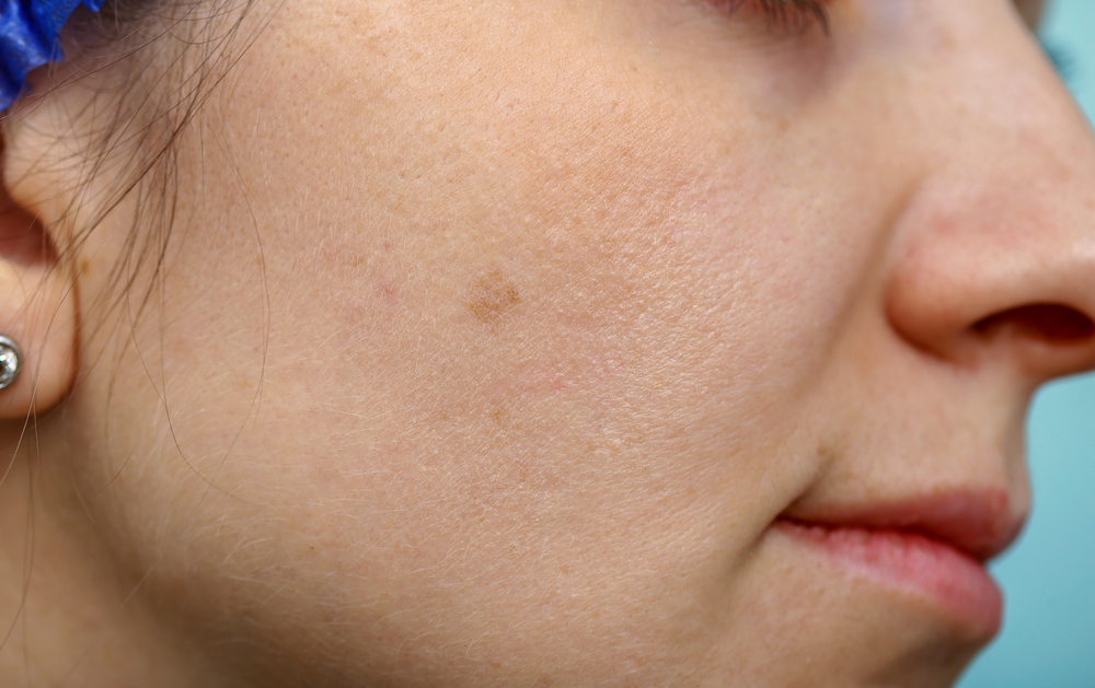 skin damage from silvadene cream