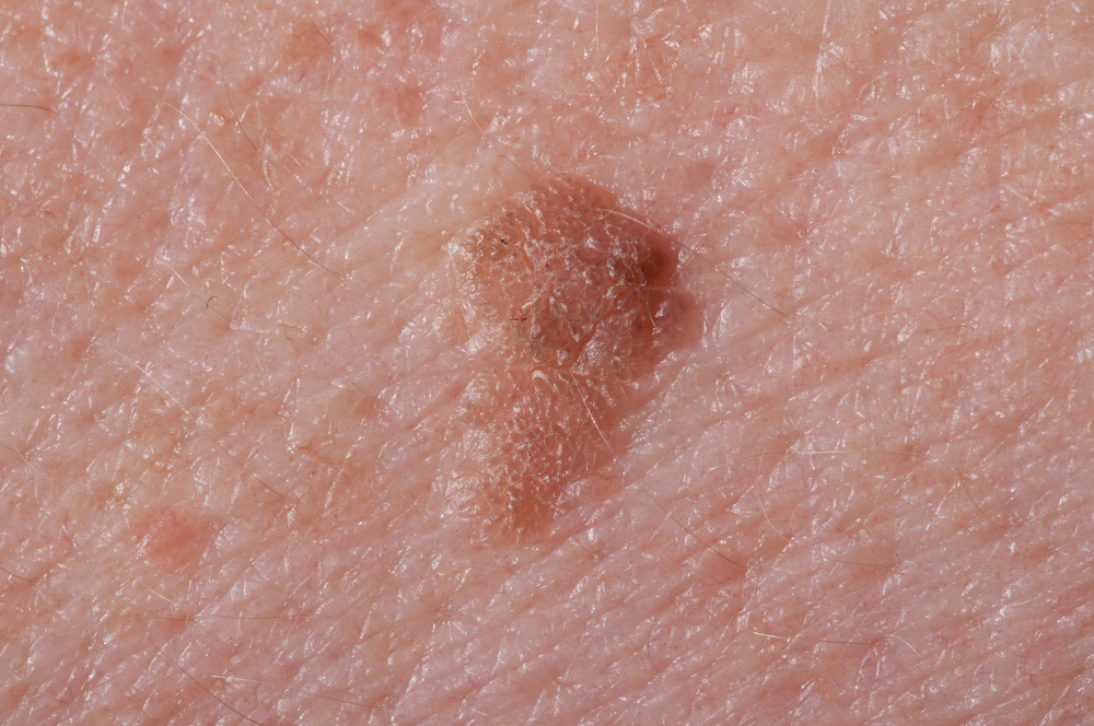 test for skin cancer