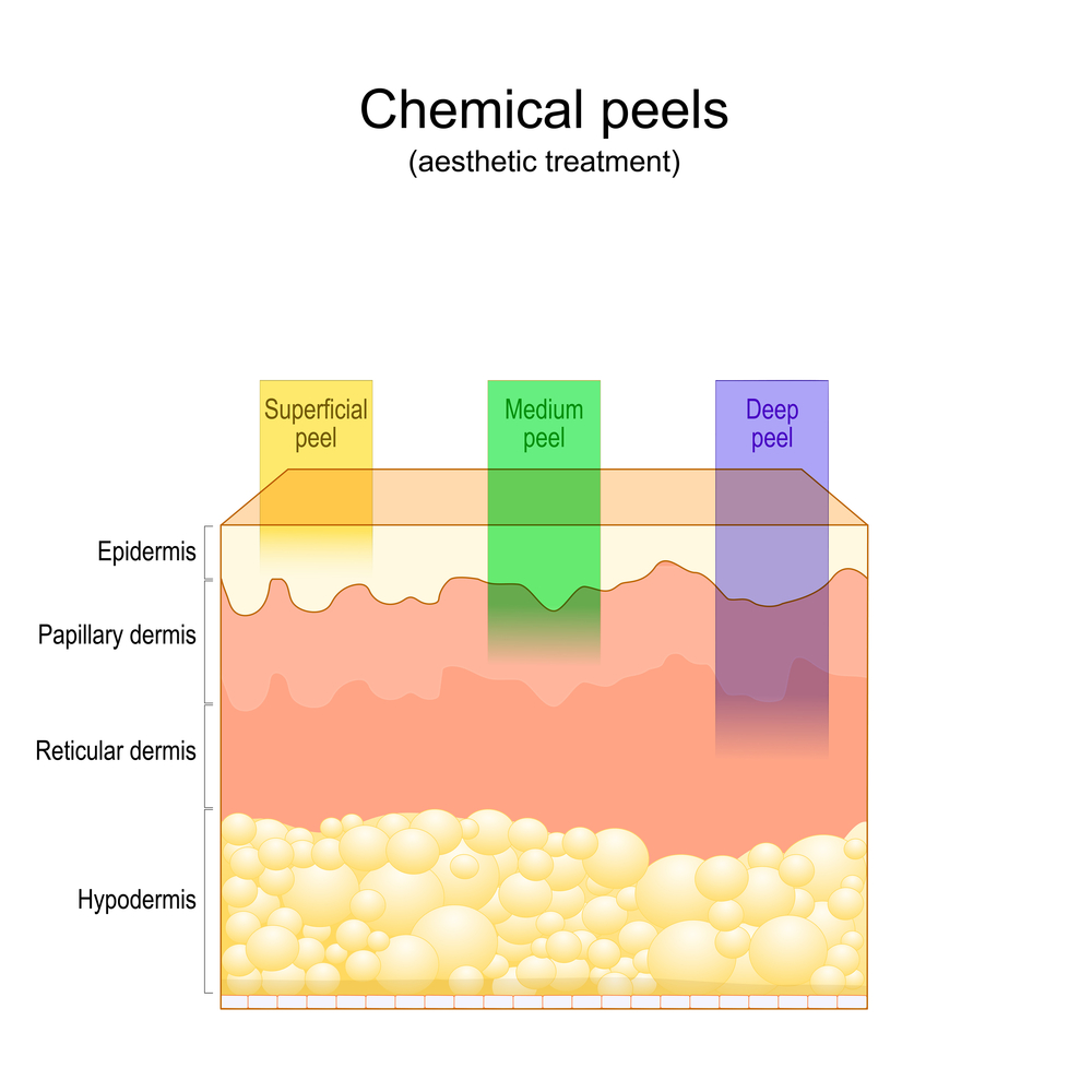 How Long Do Chemical Peels Last?
