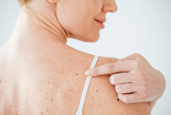 mole removal near me