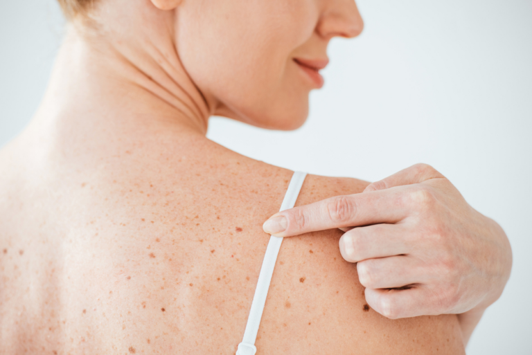 how-long-does-mole-removal-take-steele-creek-dermatology